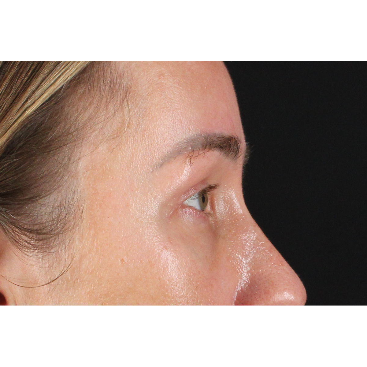Eyelid Surgery Before & After Patient #3361