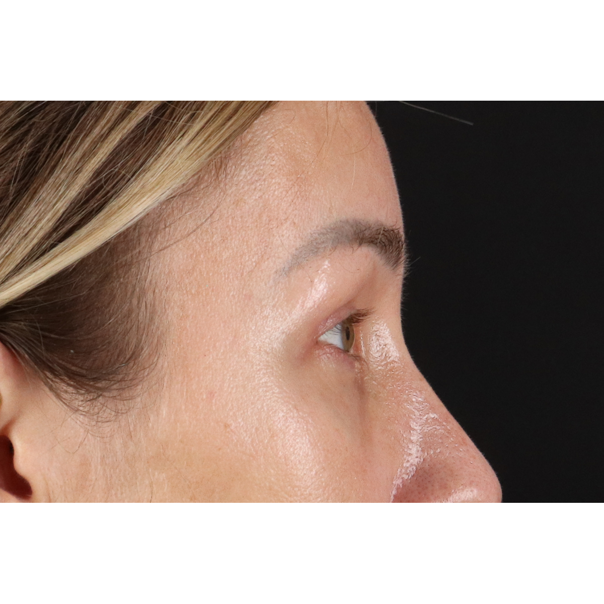 Eyelid Surgery Before & After Patient #3361