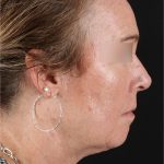 Laser Before & After Patient #3362