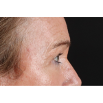 Eyelid Surgery Before & After Patient #3363