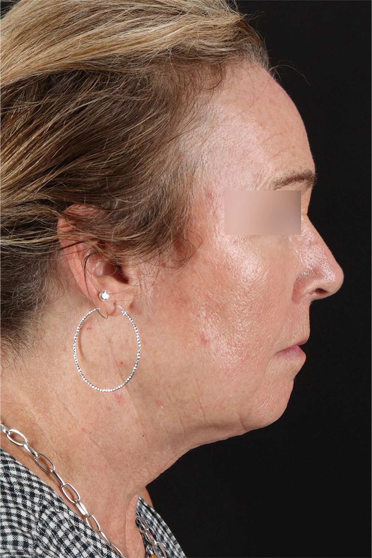Laser Before & After Patient #3362