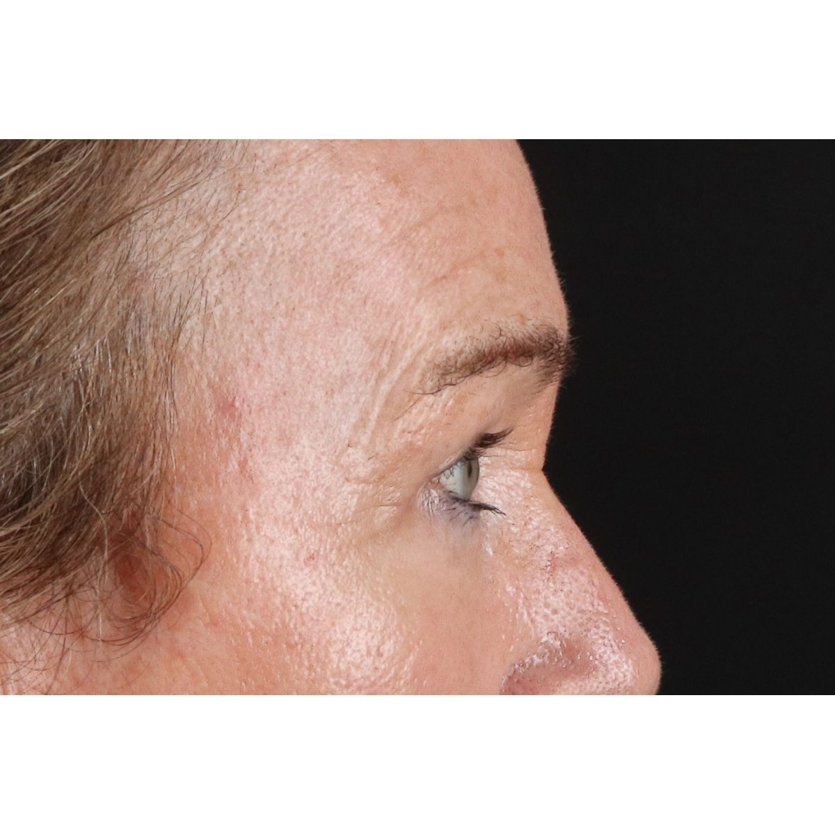 Eyelid Surgery Before & After Patient #3363
