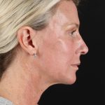 Ponytail Facelift Before & After Patient #3118
