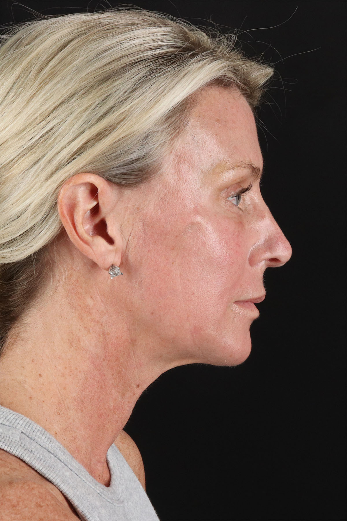 Ponytail Facelift Before & After Patient #3118