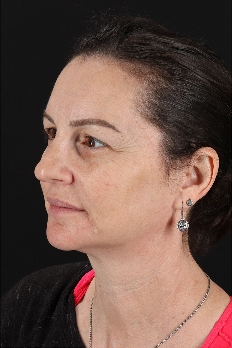 Chemical Peel Before & After Patient #3470