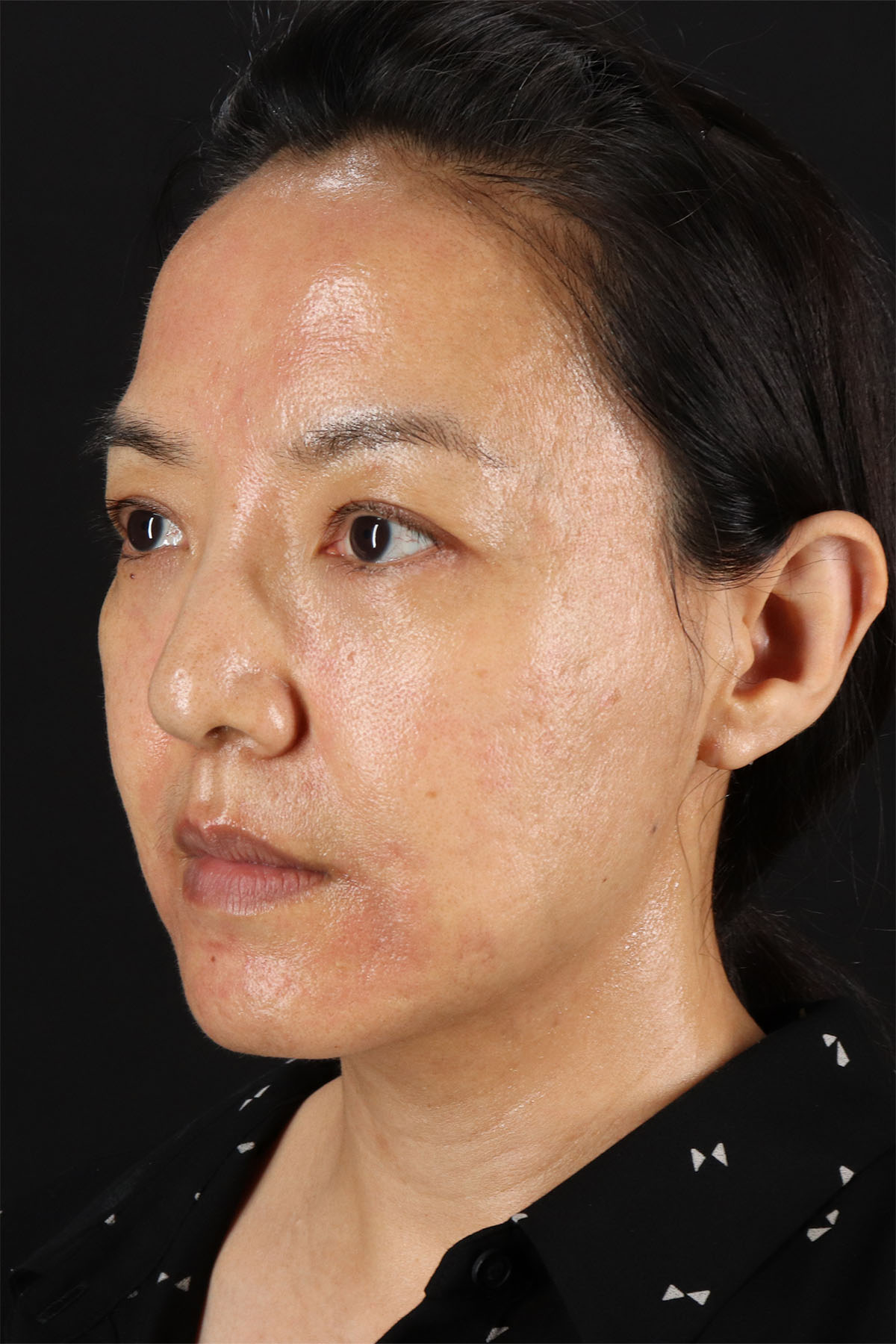 Skin Resurfacing / Laser Before & After Patient #3001