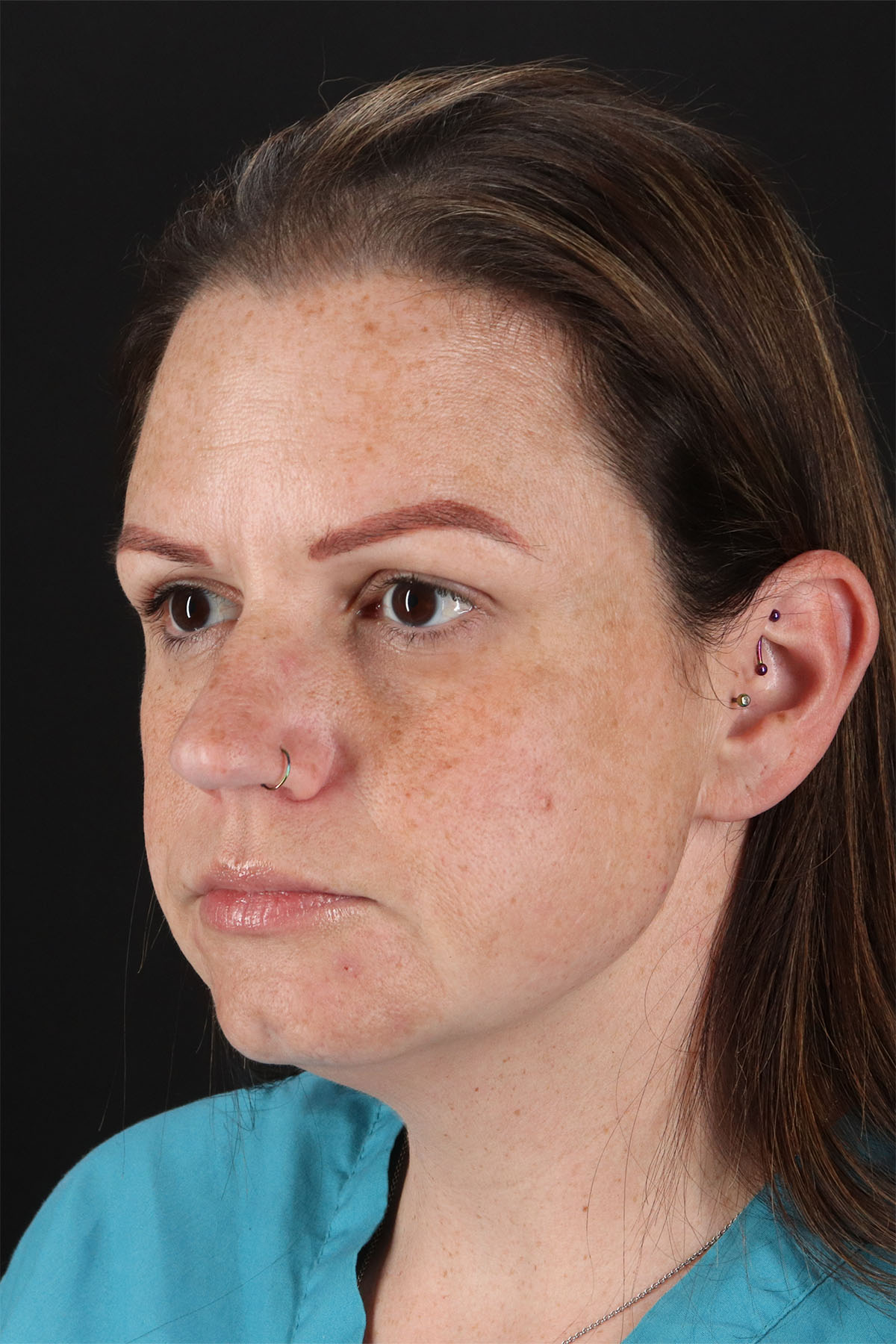 Chemical Peel Before & After Patient #3002