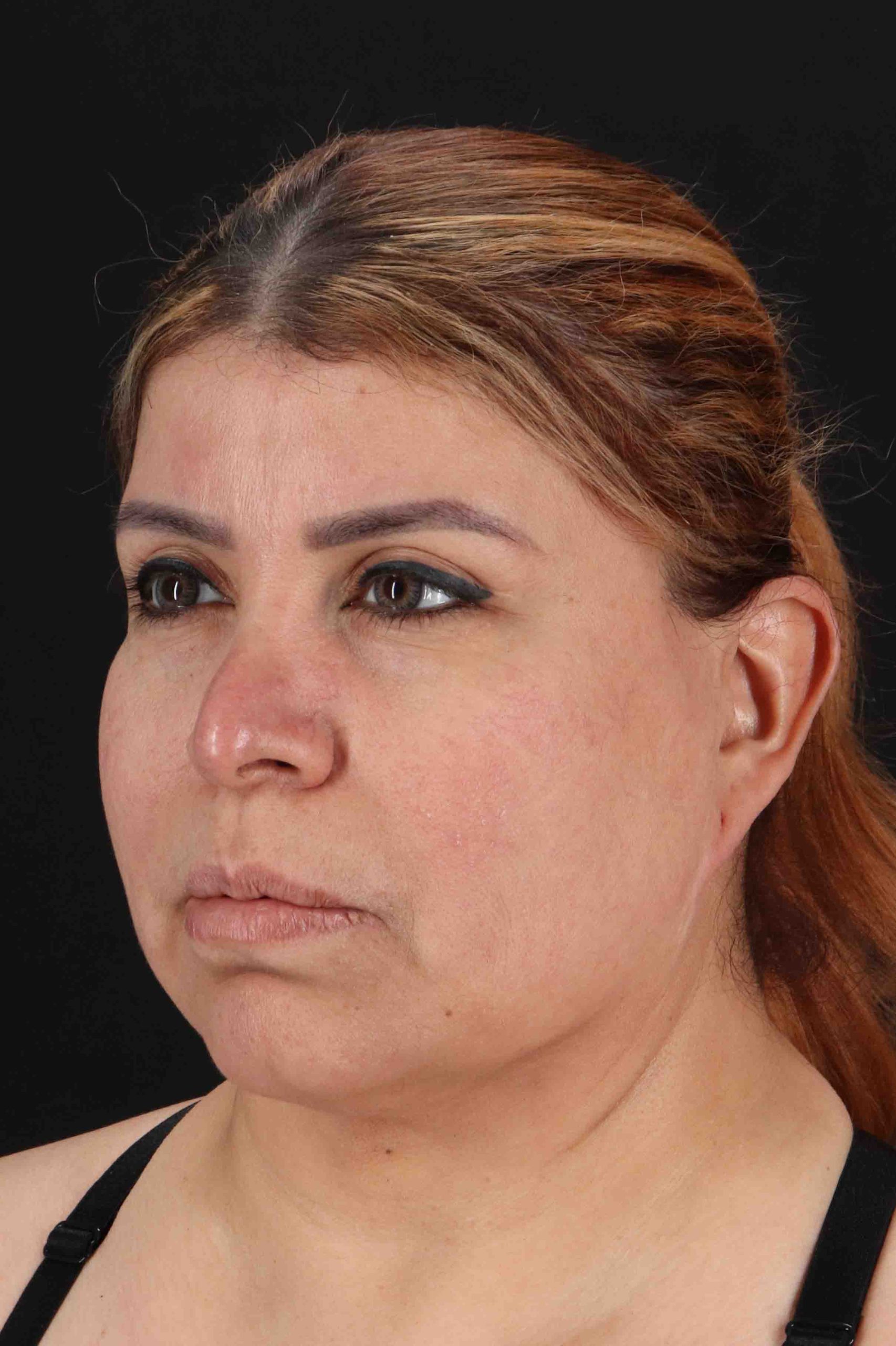 Structural Fat Grafting Before & After Patient #3642