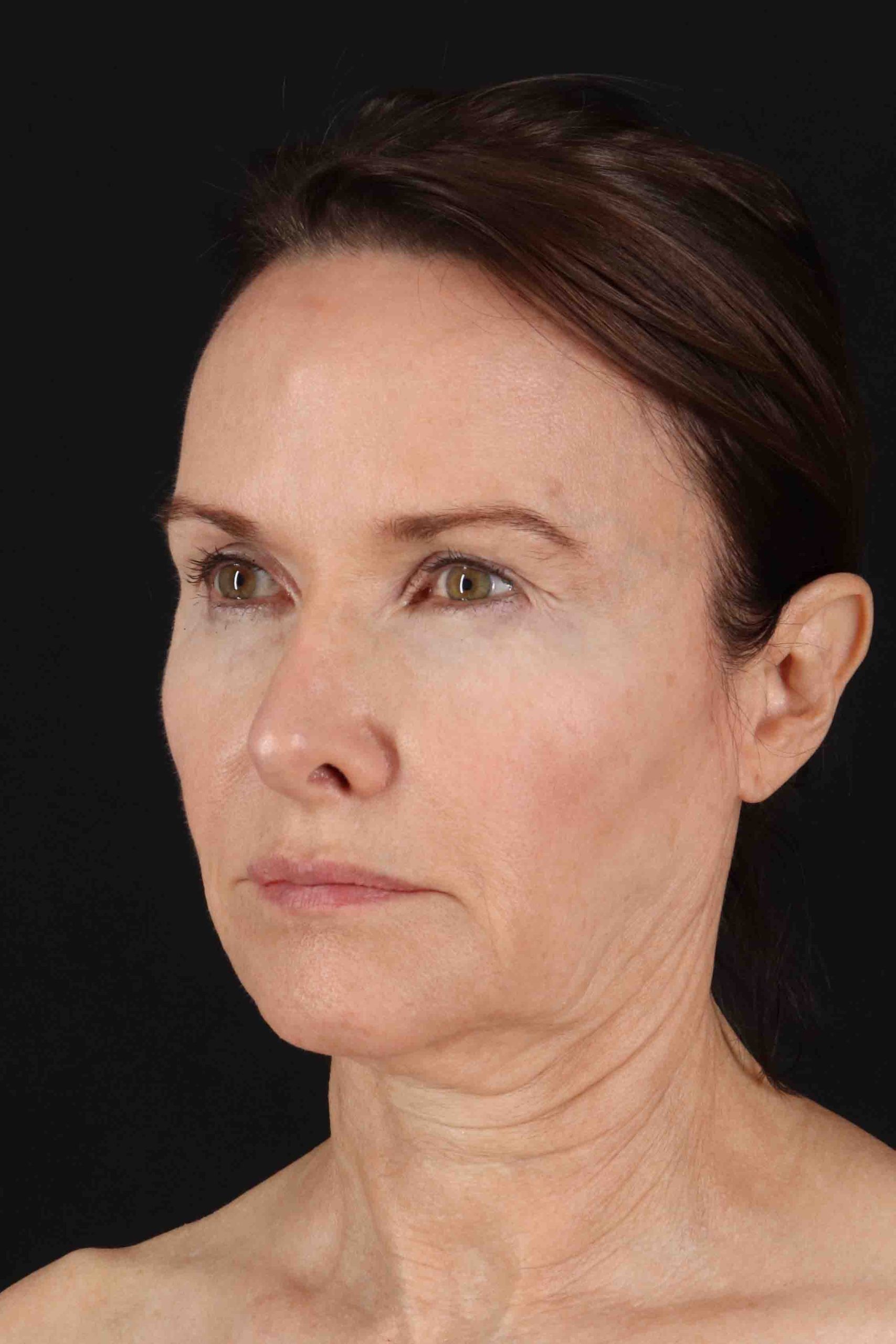 Structural Fat Grafting Before & After Patient #3643