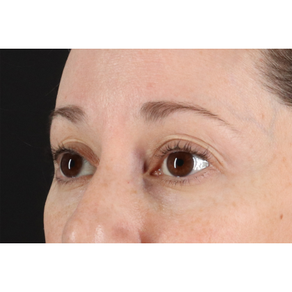 Eyelid Surgery Before & After Patient #3006
