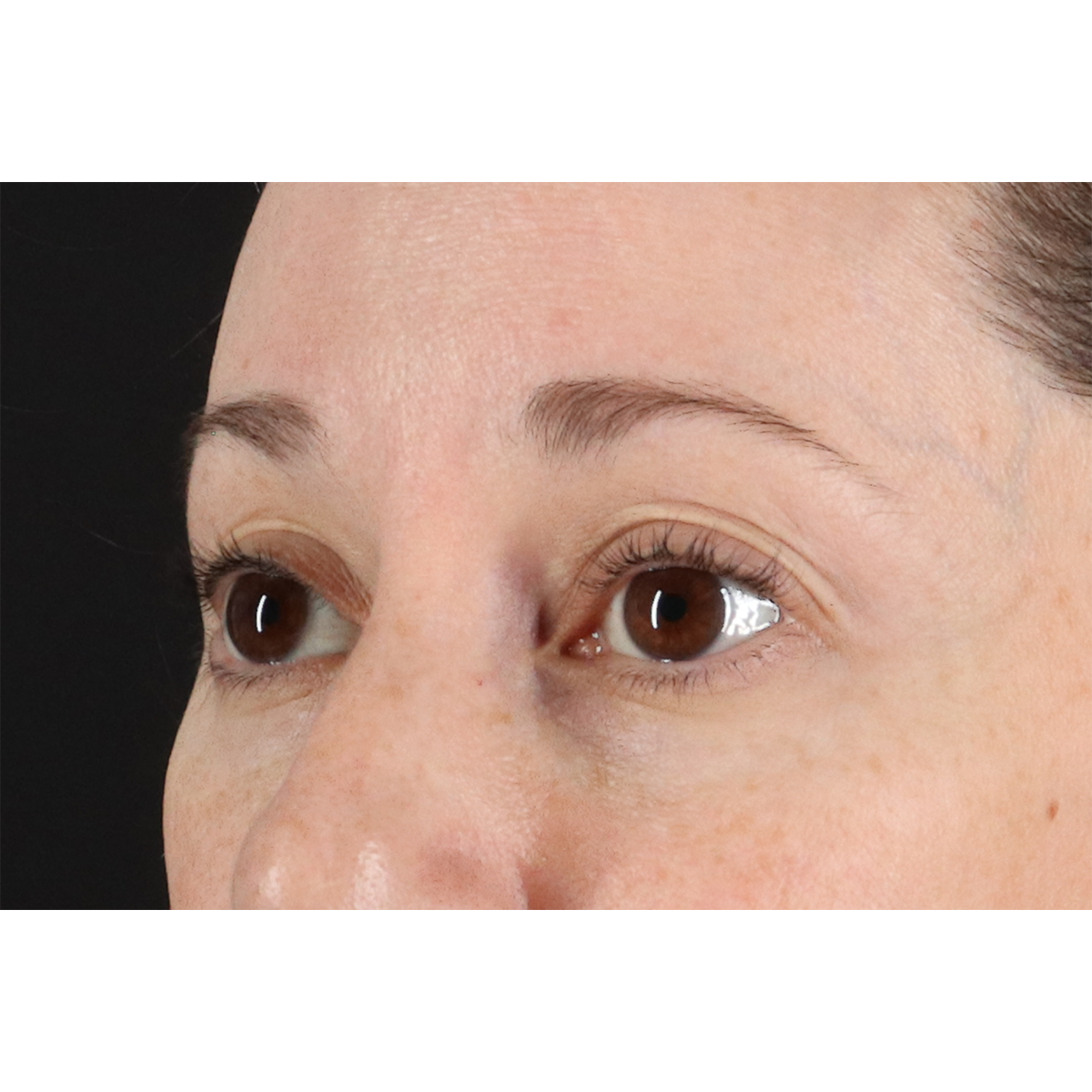 Eyelid Surgery Before & After Patient #3006