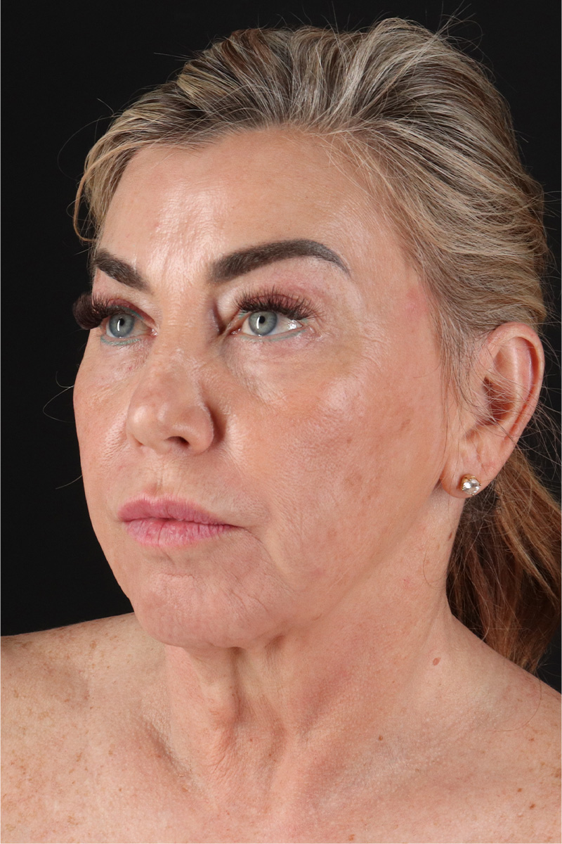 Neck Lift Before & After Patient #3476
