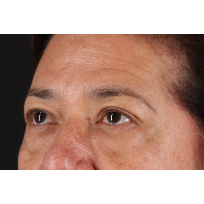 Eyelid Surgery Before & After Patient #3008
