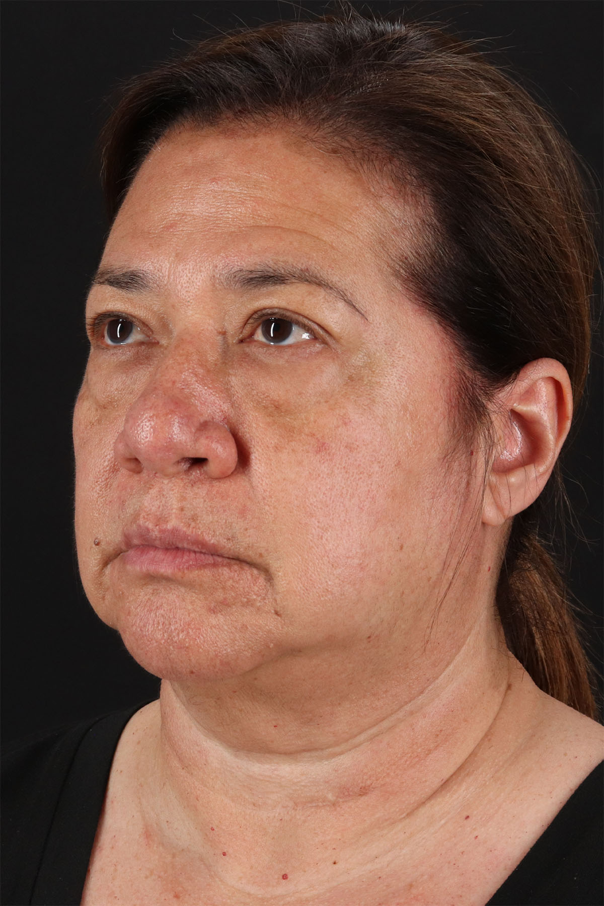 CO2 Laser Before & After Patient #3009