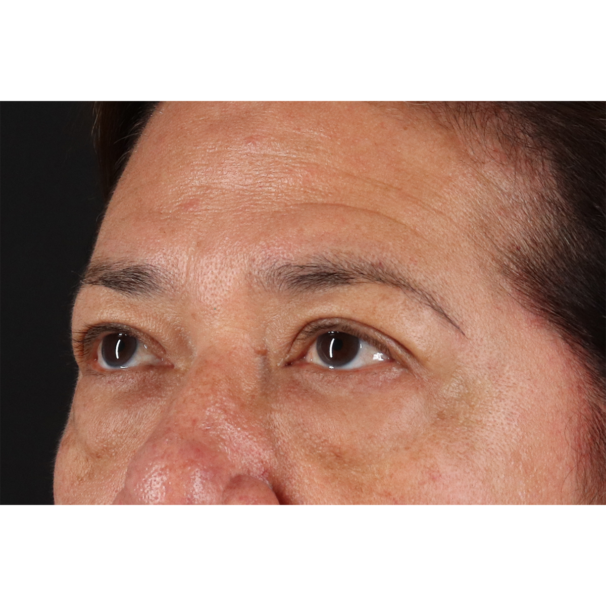 Eyelid Surgery Before & After Patient #3008