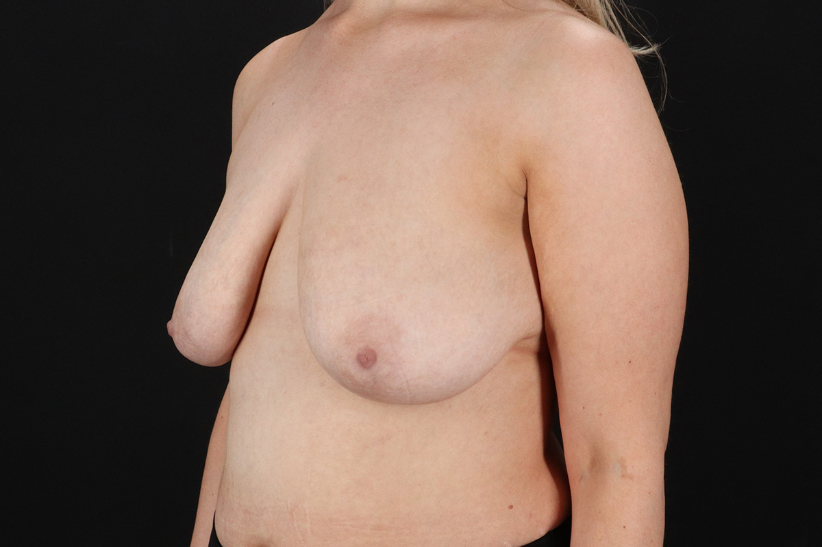 Breast Reduction with Lift Before & After Patient #3477