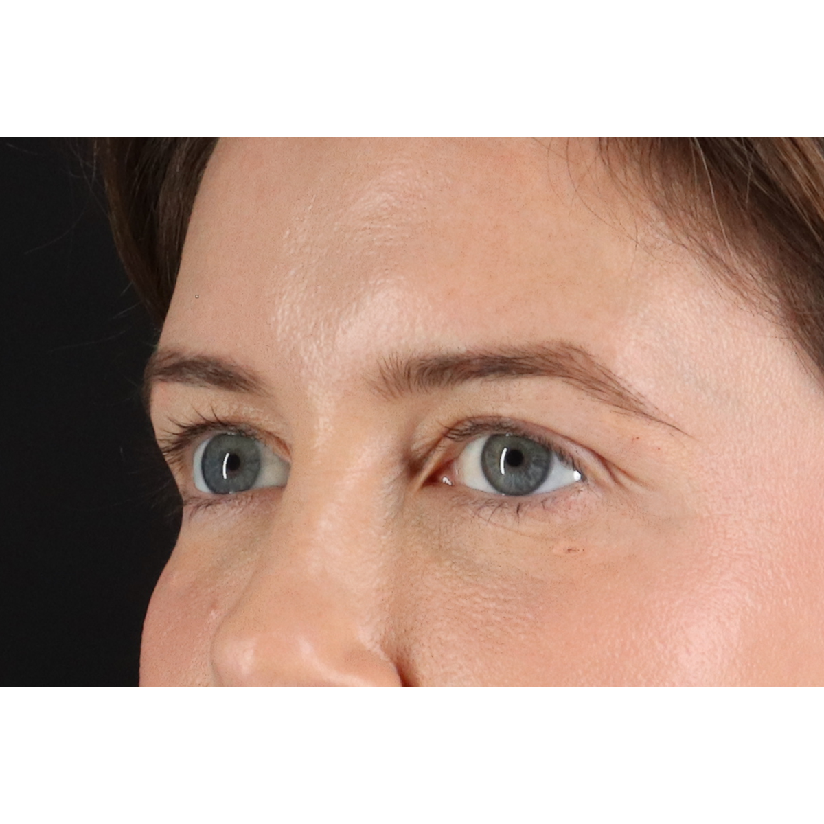Eyelid Surgery Before & After Patient #3570