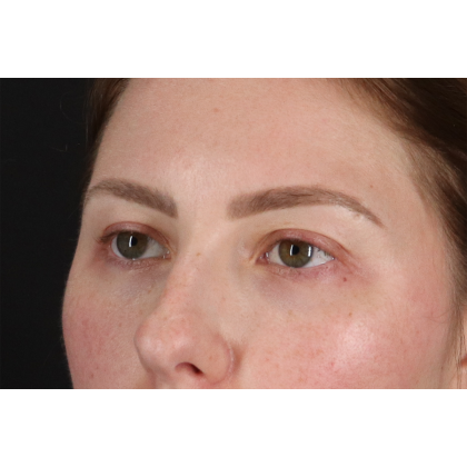 Brow Lift Before & After Patient #3111