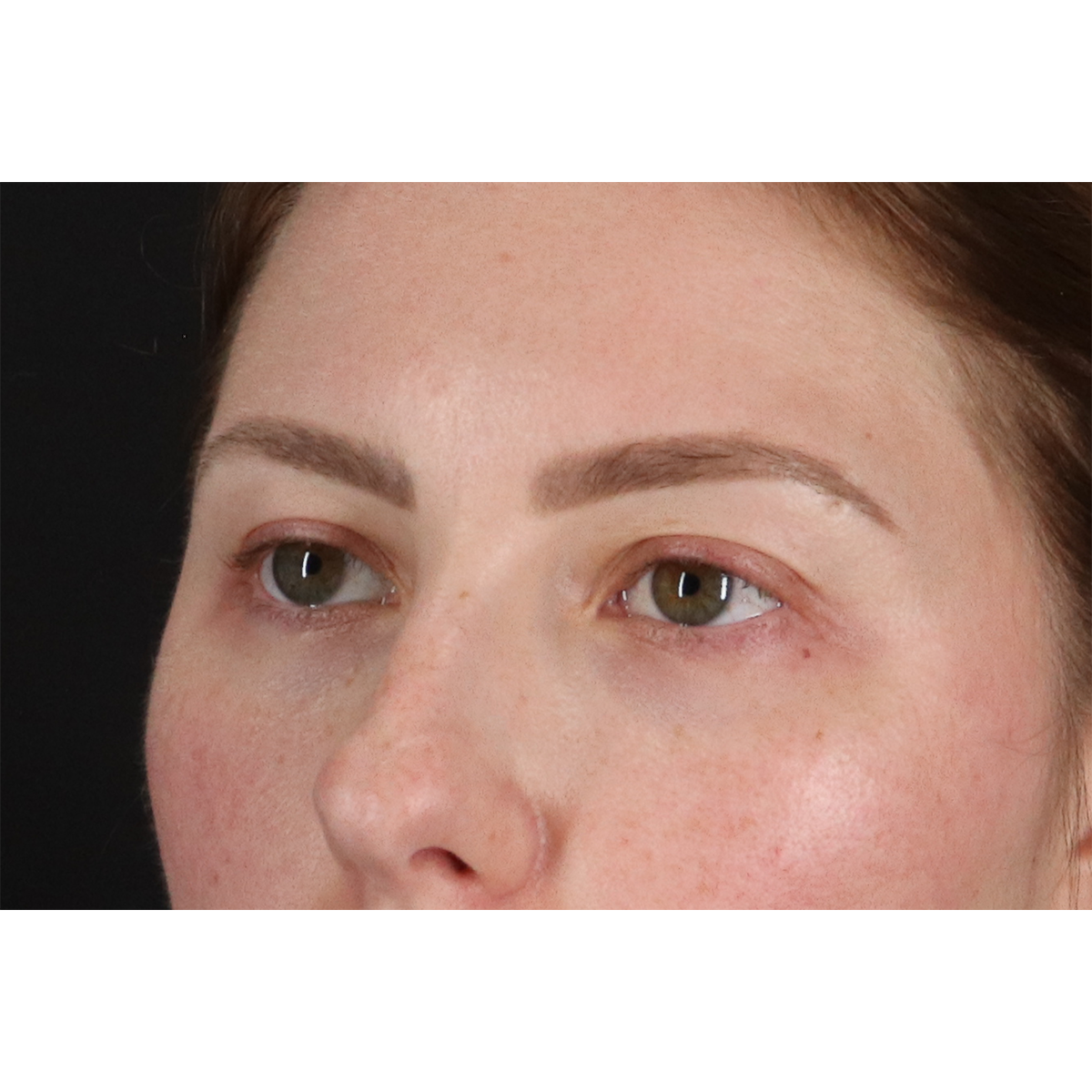 Brow Lift Before & After Patient #3111