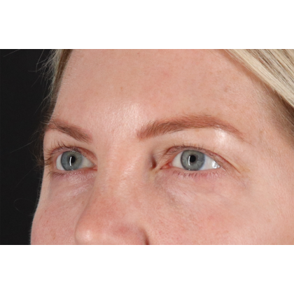 Eyelid Surgery Before & After Patient #3112
