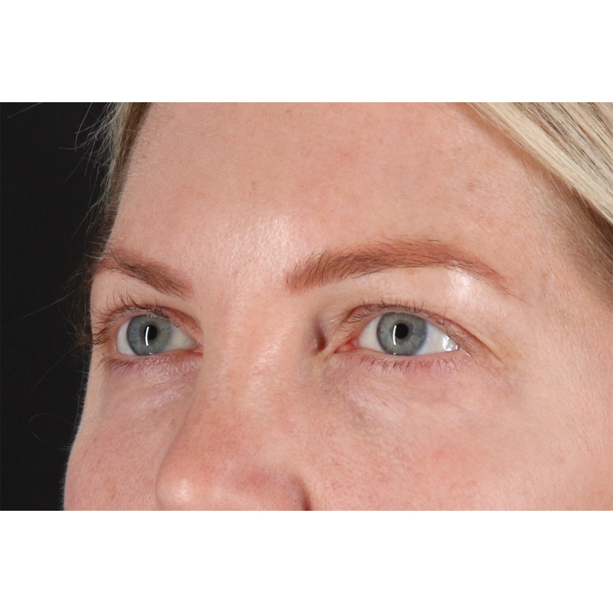 Eyelid Surgery Before & After Patient #3112