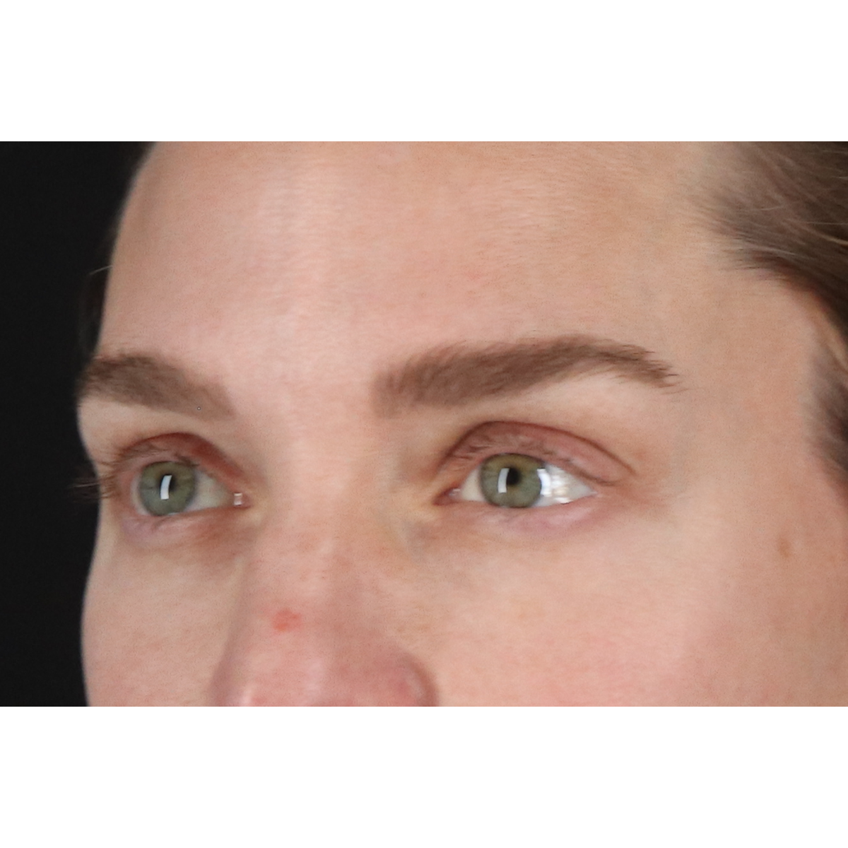 Eyelid Surgery Before & After Patient #3571