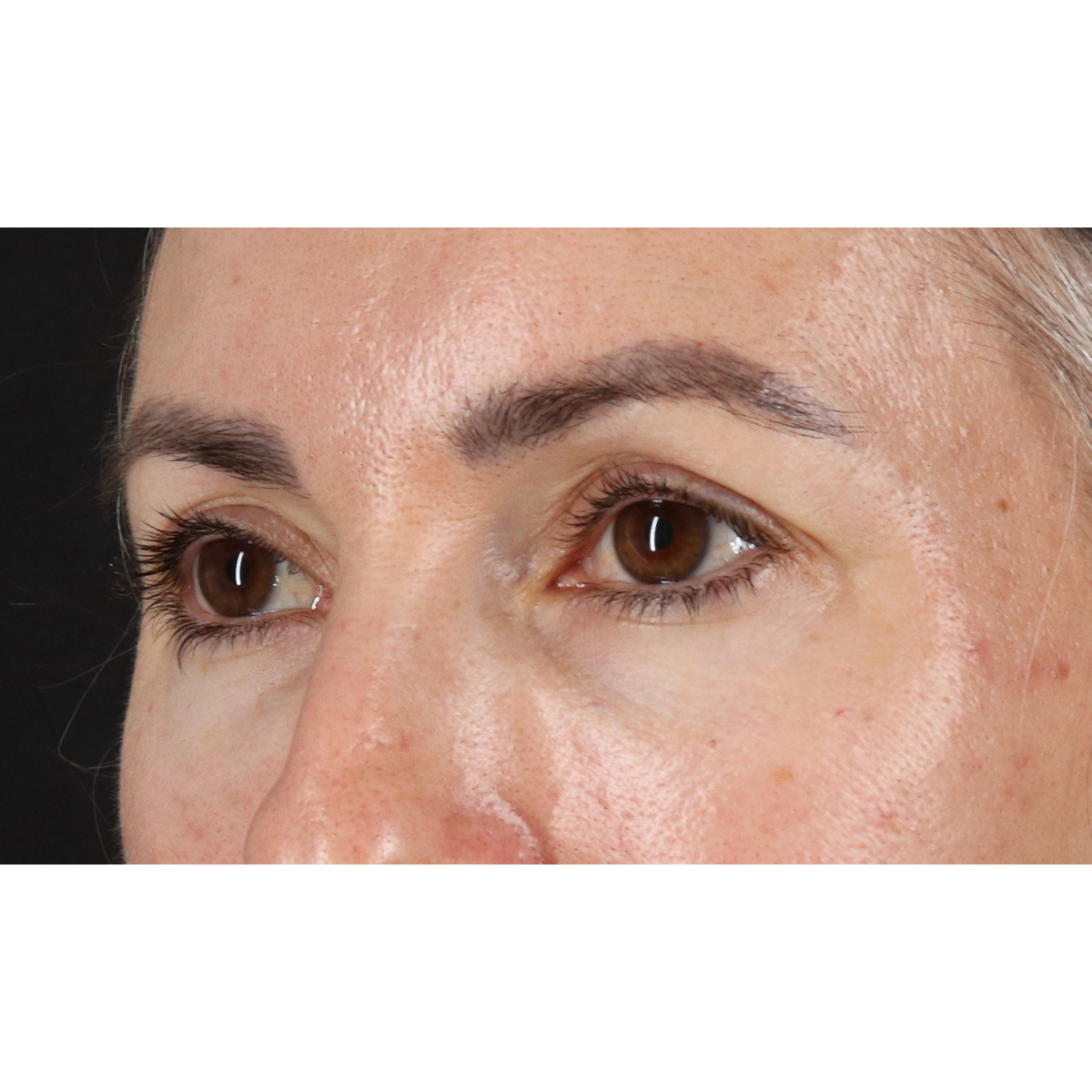Eyelid Surgery Before & After Patient #3356