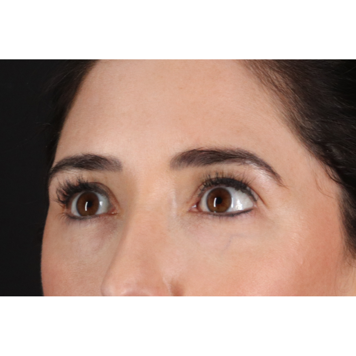 Eyelid Surgery Before & After Patient #3358