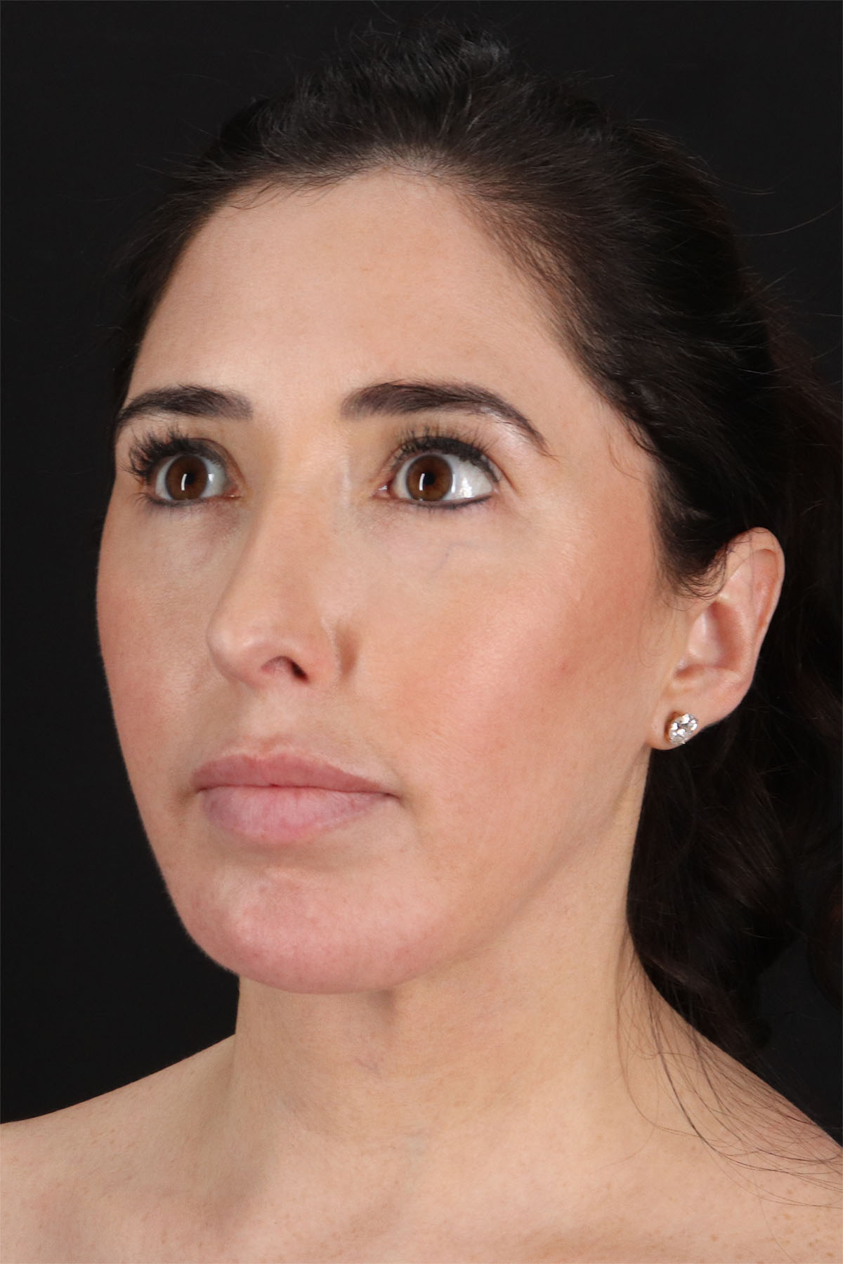 Structural Fat Grafting Before & After Patient #3649