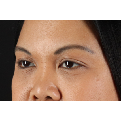 Brow Lift Before & After Patient #3114