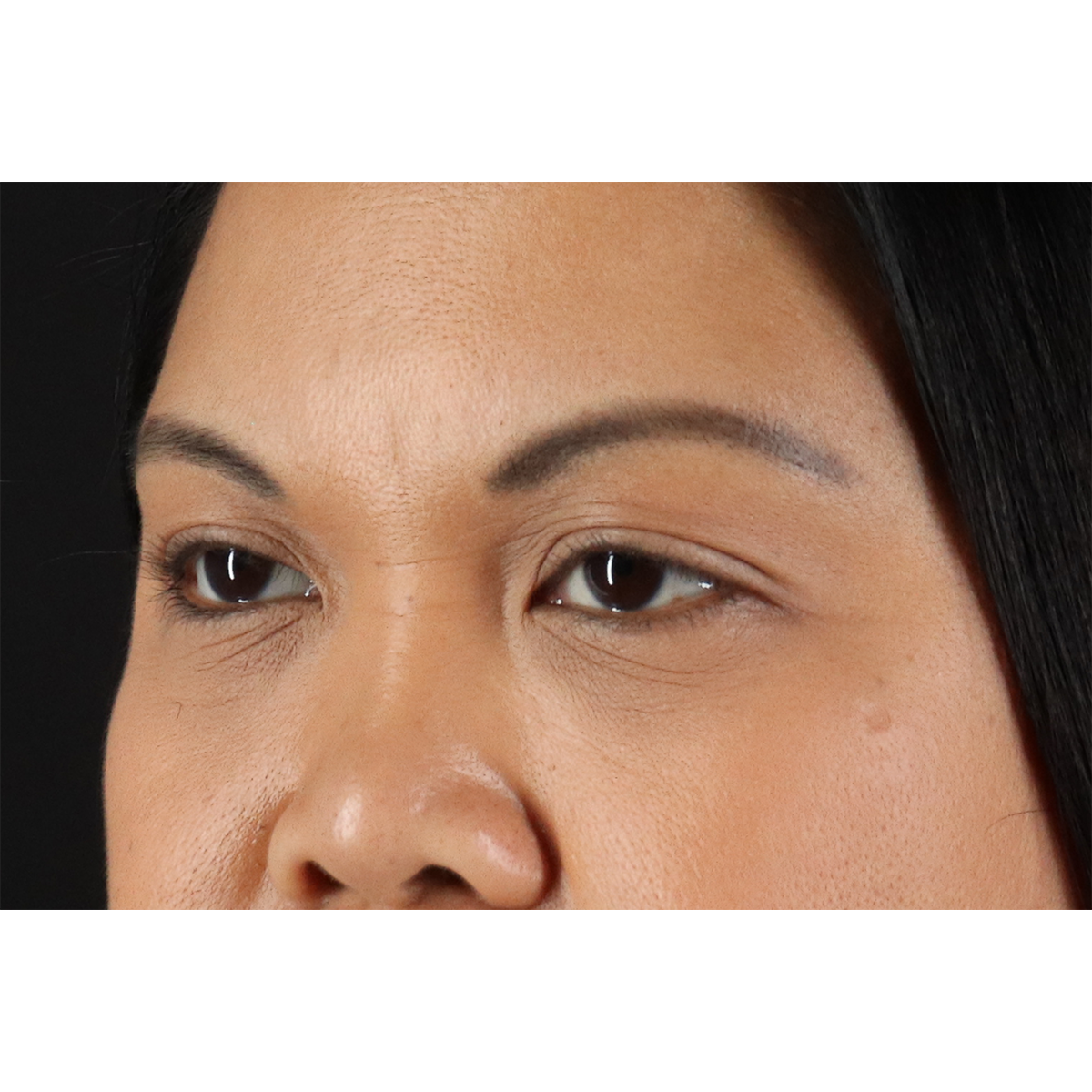 Brow Lift Before & After Patient #3114
