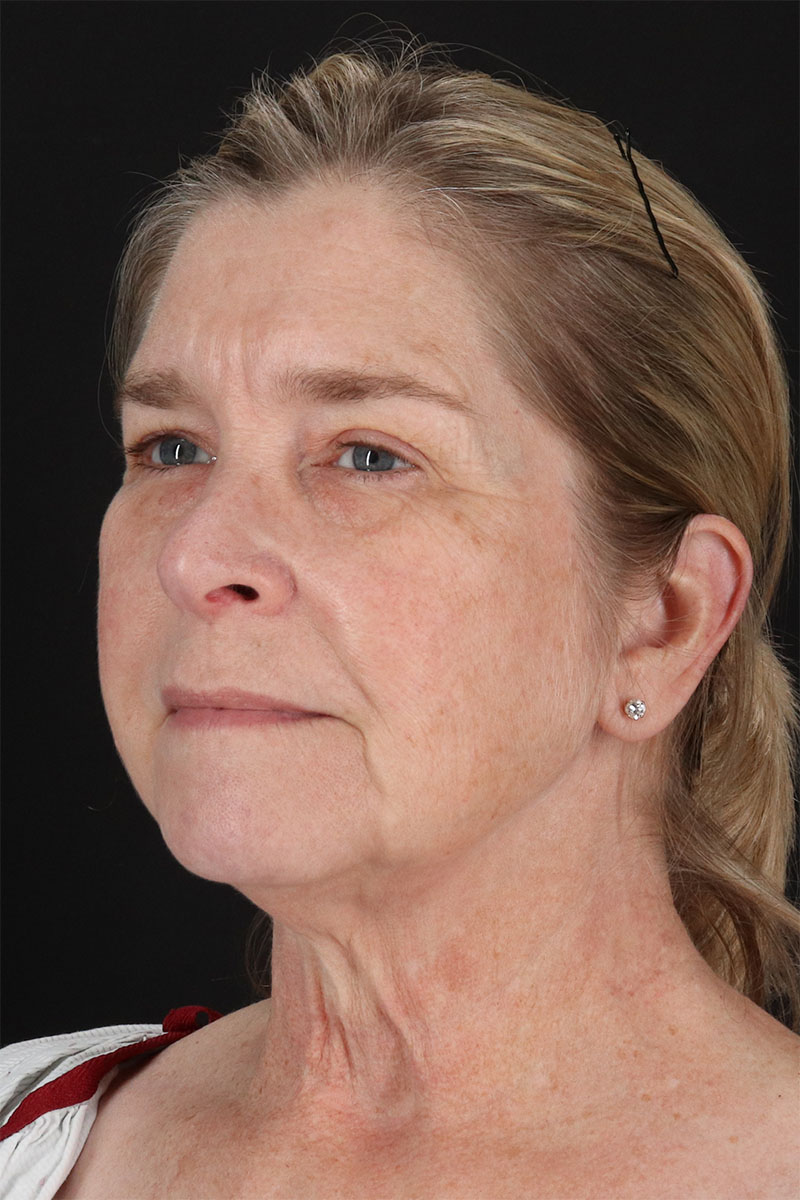 CO2 Laser Before & After Patient #3116