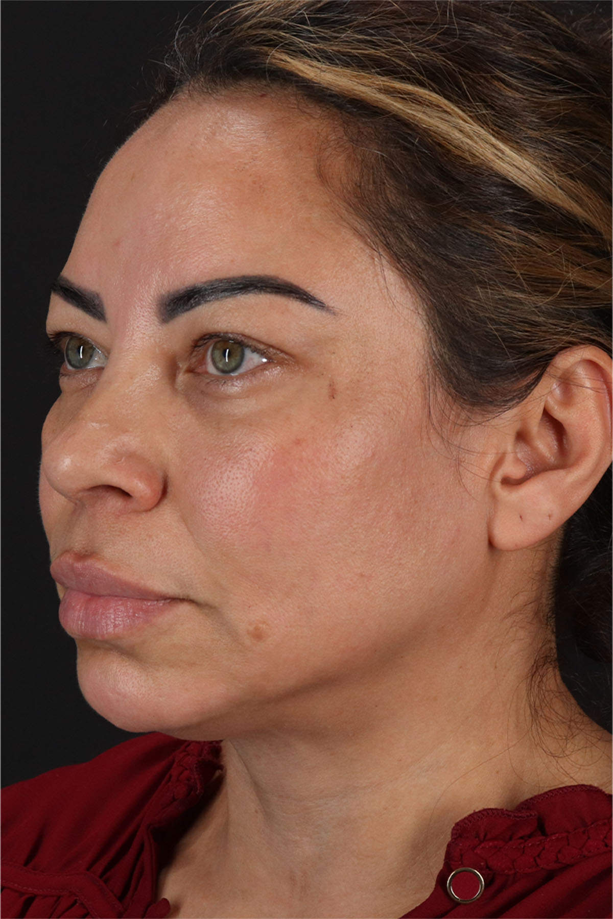 Laser Before & After Patient #3359