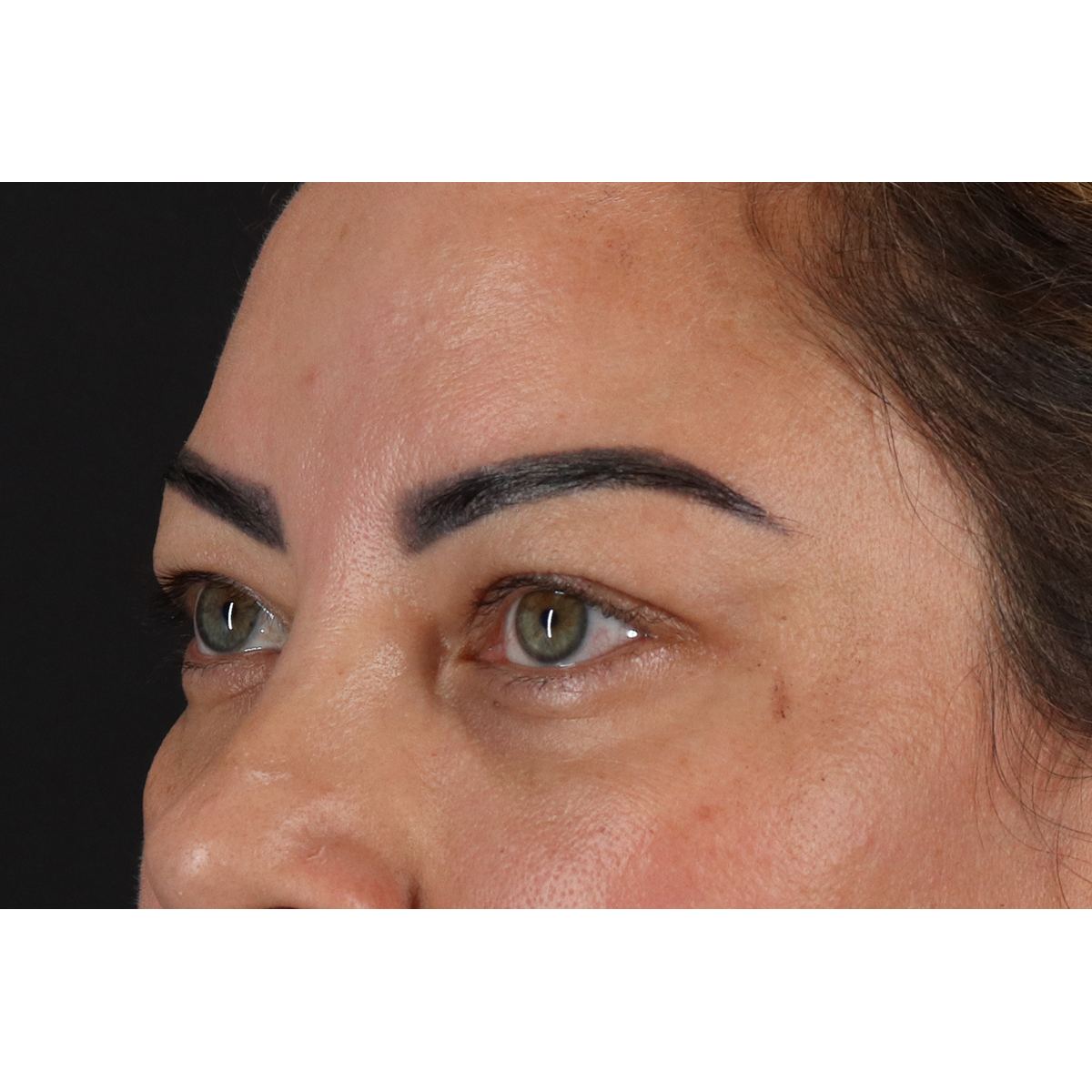 Eyelid Surgery Before & After Patient #3360