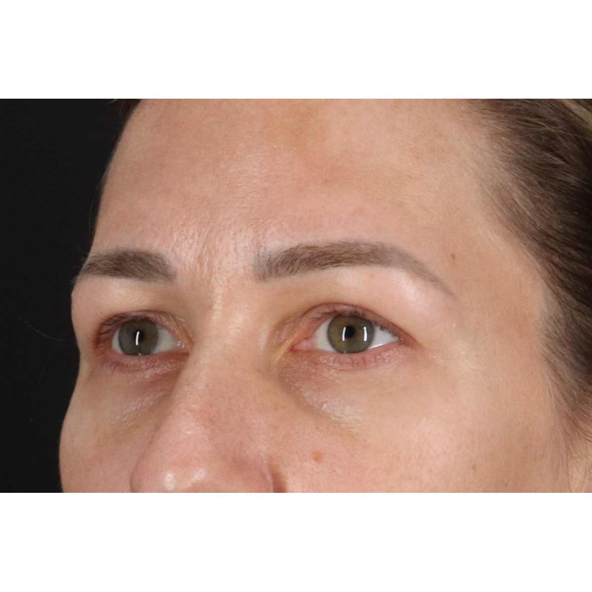 Eyelid Surgery Before & After Patient #3361