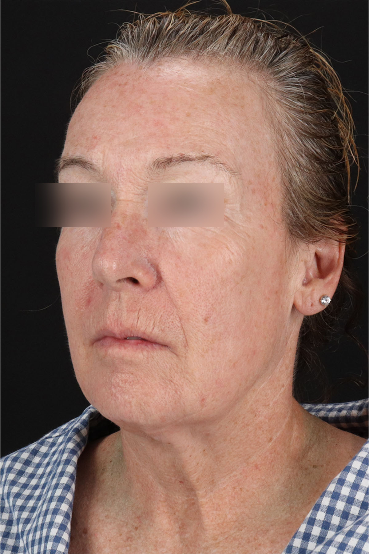 Laser Before & After Patient #3362