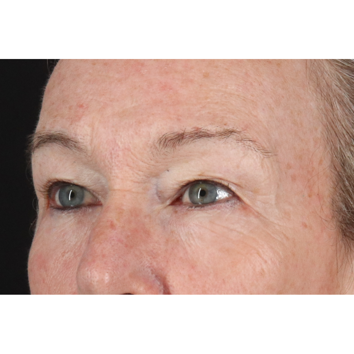 Eyelid Surgery Before & After Patient #3363