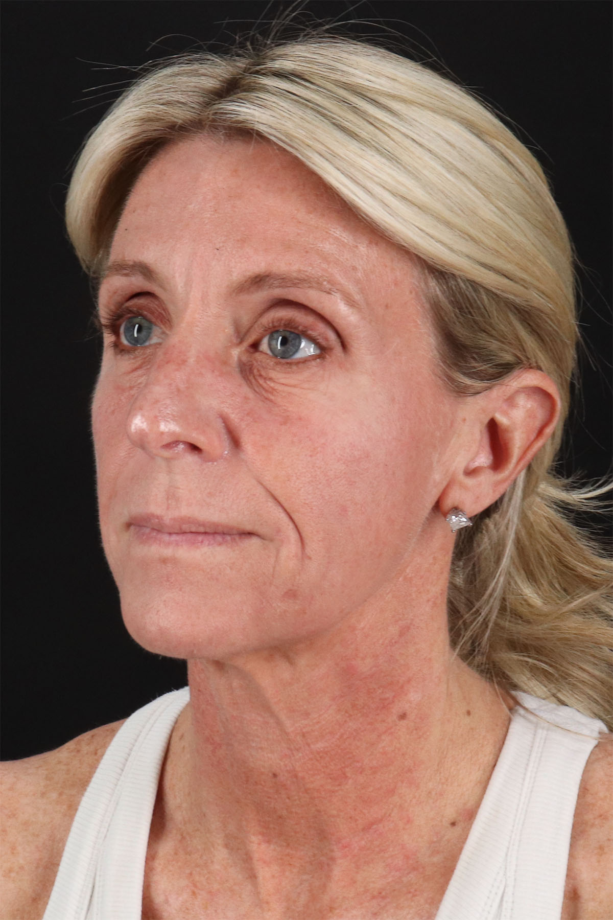 Ponytail Facelift Before & After Patient #3118