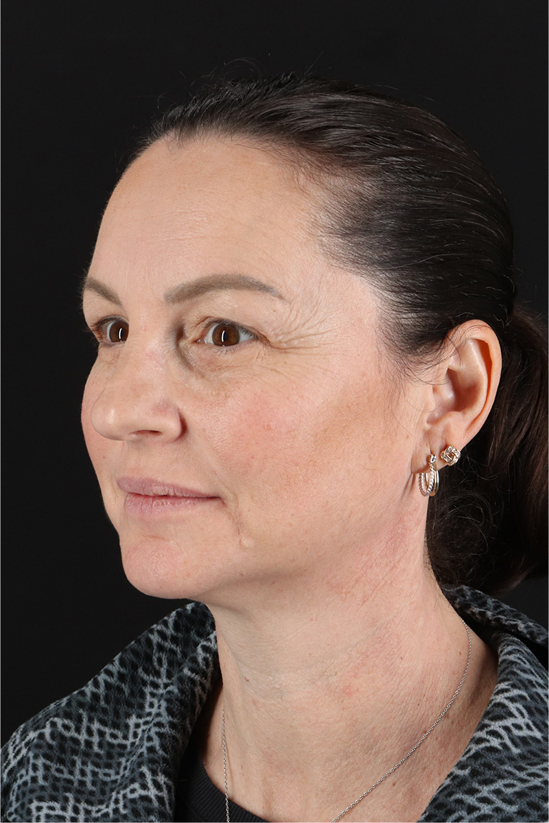 Chemical Peel Before & After Patient #3470
