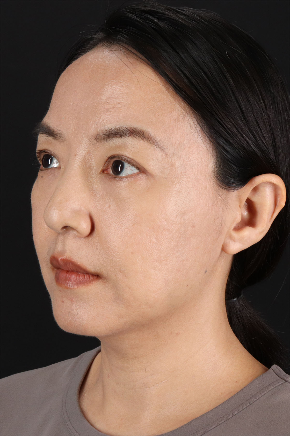 Skin Resurfacing / Laser Before & After Patient #3001
