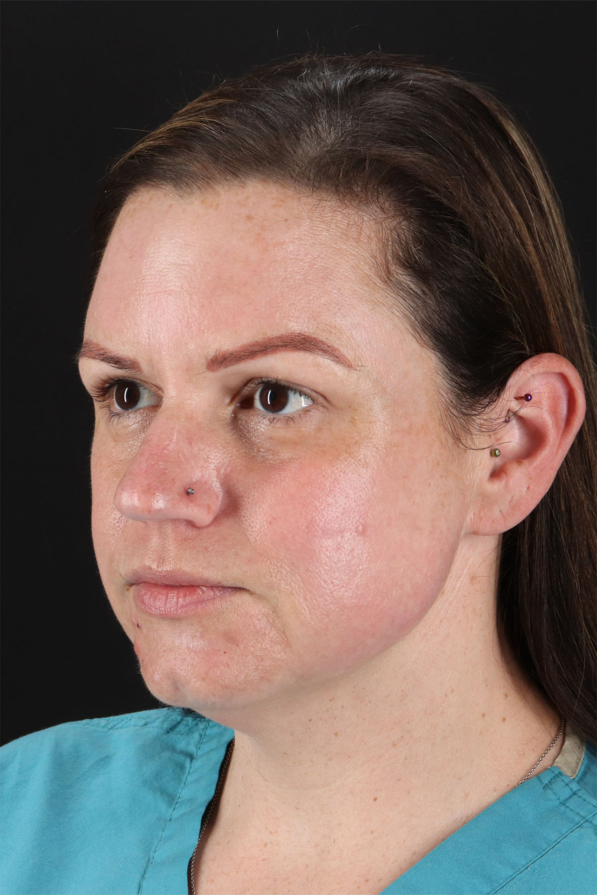 Chemical Peel Before & After Patient #3002