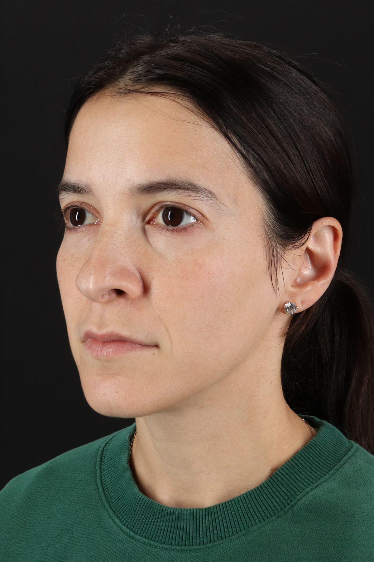 CO2 Laser Before & After Patient #3005