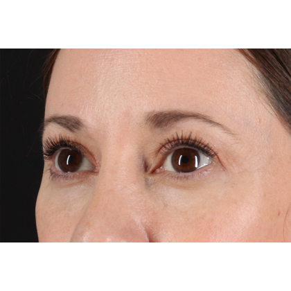Eyelid Surgery Before & After Patient #3006