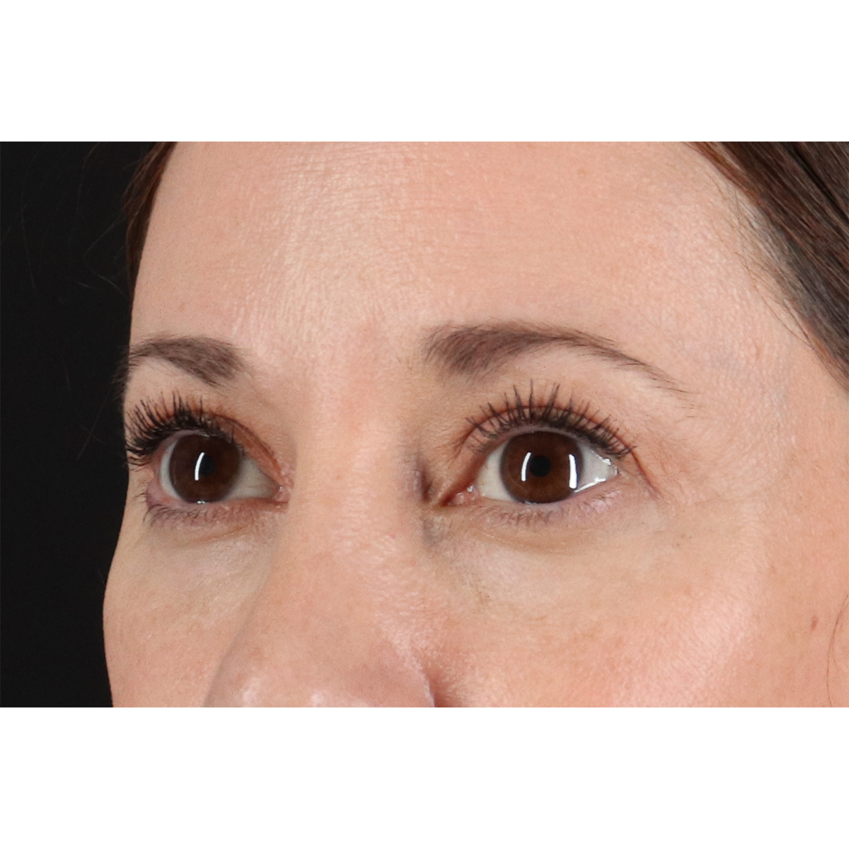 Eyelid Surgery Before & After Patient #3006