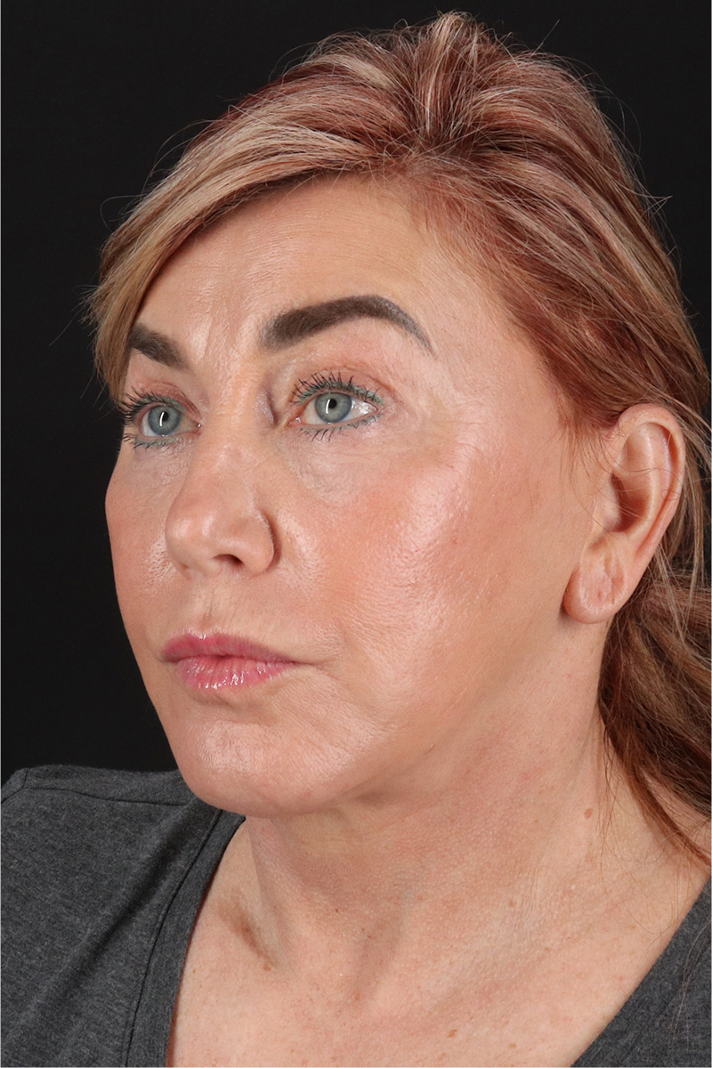 Neck Lift Before & After Patient #3476