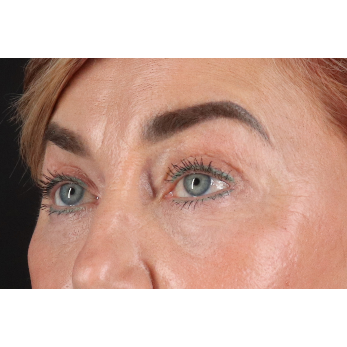 Eyelid Surgery Before & After Patient #3475