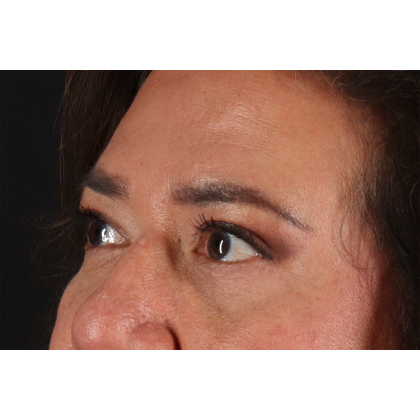 Eyelid Surgery Before & After Patient #3008