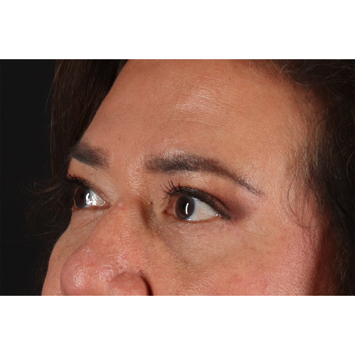 Eyelid Surgery Before & After Patient #3008