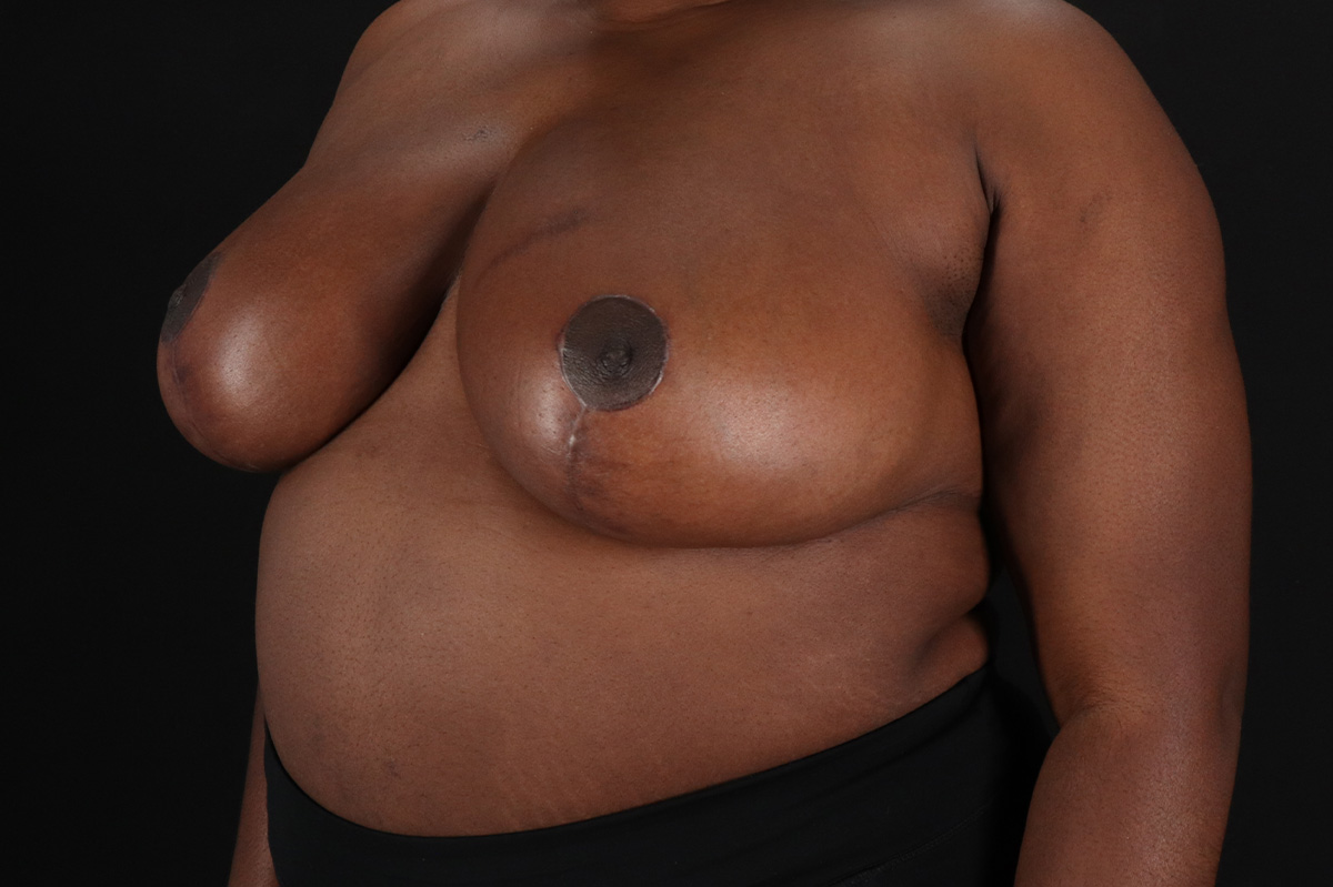 Breast Reduction with Lift Before & After Patient #3478