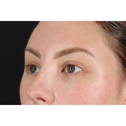 Brow Lift Before & After Patient #3111
